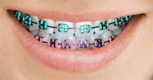 AlignBeauty-metal-braces