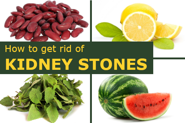 Kidney stones